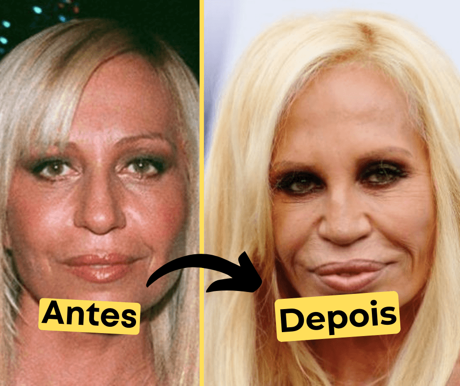 Donatella Versace  Botox, Cirurgia plastica, Cirurgias